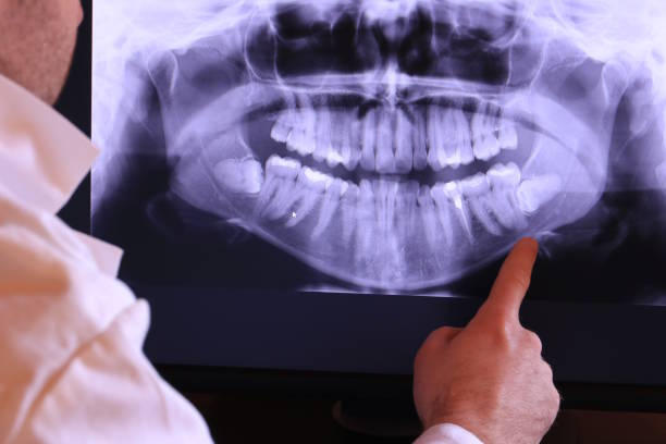 Best Emergency Root Canal Treatment in New Paleste, IN